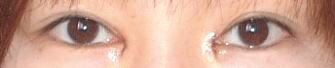 目頭切開